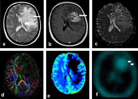 Recurrence of glioblastoma after radio